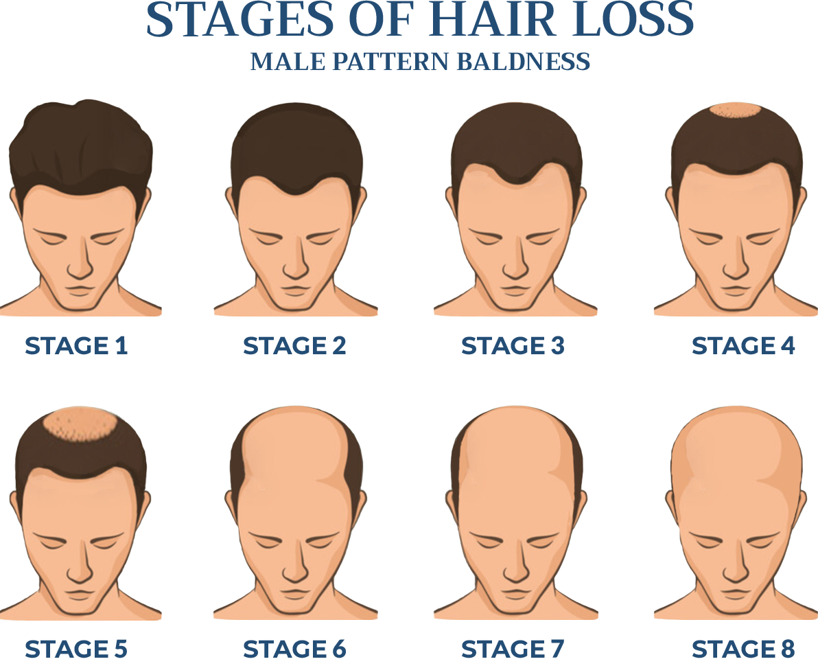 Male Pattern Hair Loss – Turkey In Health